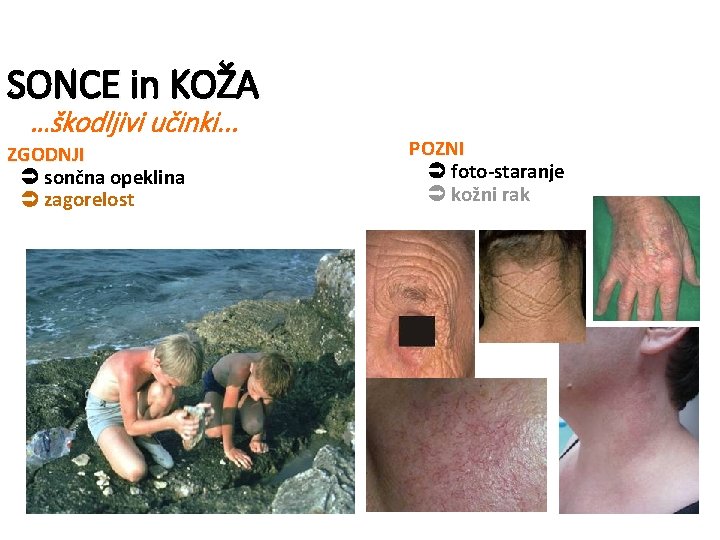 SONCE in KOŽA …škodljivi učinki. . . ZGODNJI sončna opeklina zagorelost POZNI foto-staranje kožni