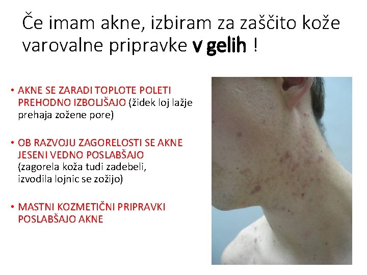 Če imam akne, izbiram za zaščito kože varovalne pripravke v gelih ! • AKNE