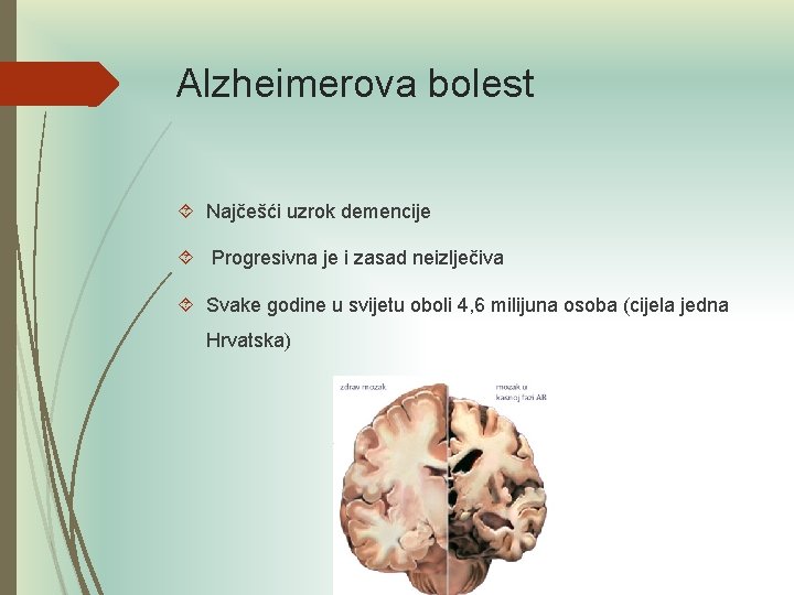 Alzheimerova bolest Najčešći uzrok demencije Progresivna je i zasad neizlječiva Svake godine u svijetu