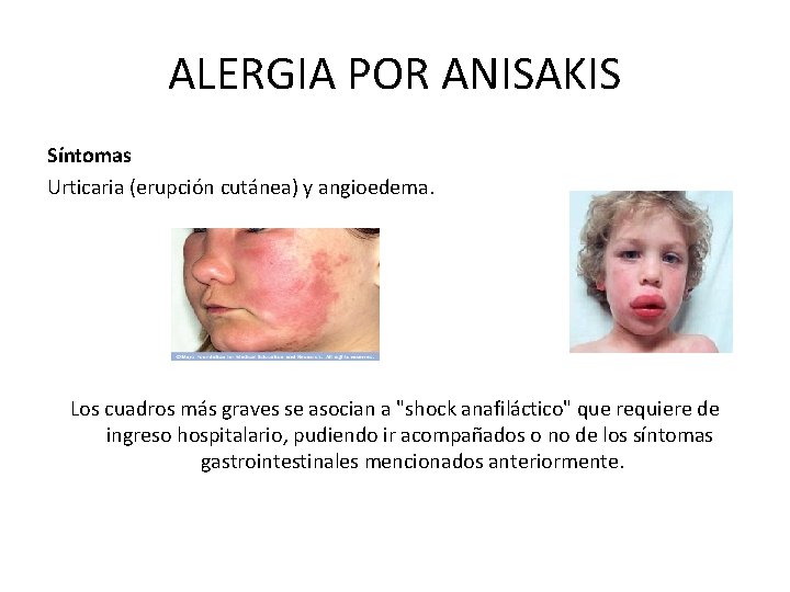 ALERGIA POR ANISAKIS Síntomas Urticaria (erupción cutánea) y angioedema. Los cuadros más graves se