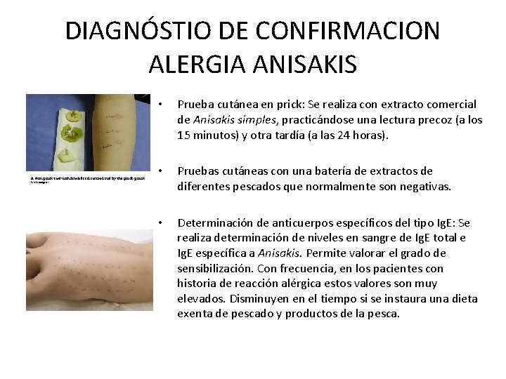 DIAGNÓSTIO DE CONFIRMACION ALERGIA ANISAKIS • Prueba cutánea en prick: Se realiza con extracto