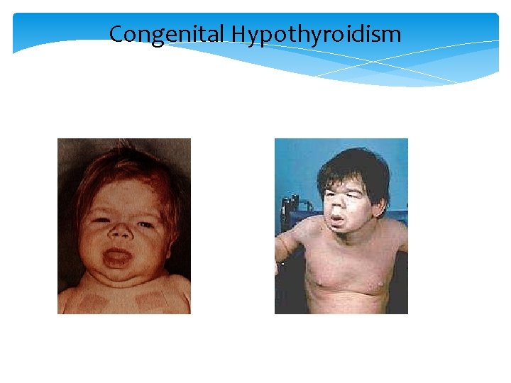 Congenital Hypothyroidism 
