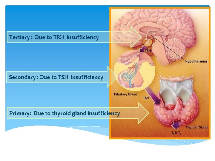 Tertiary : Due to TRH insufficiency Secondary : Due to TSH insufficiency Primary: Due