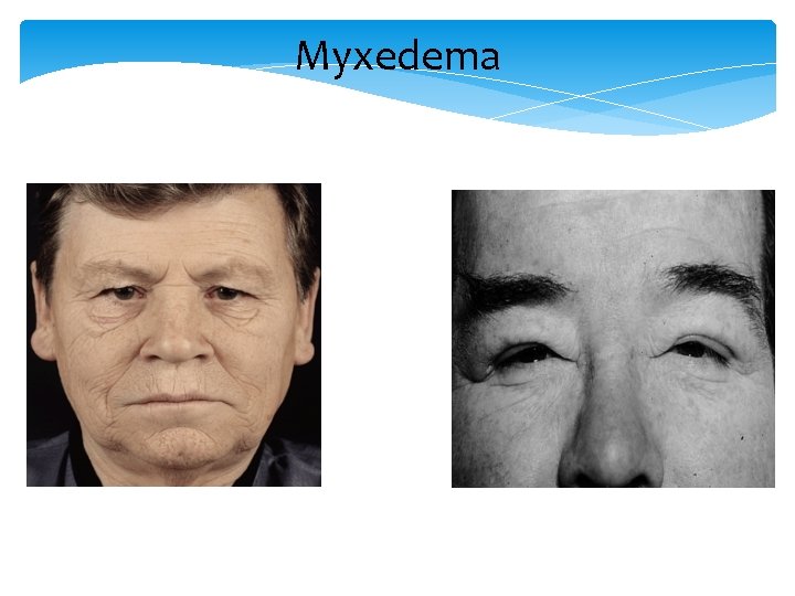 Myxedema 