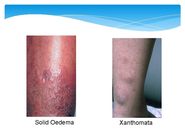 Solid Oedema Xanthomata 