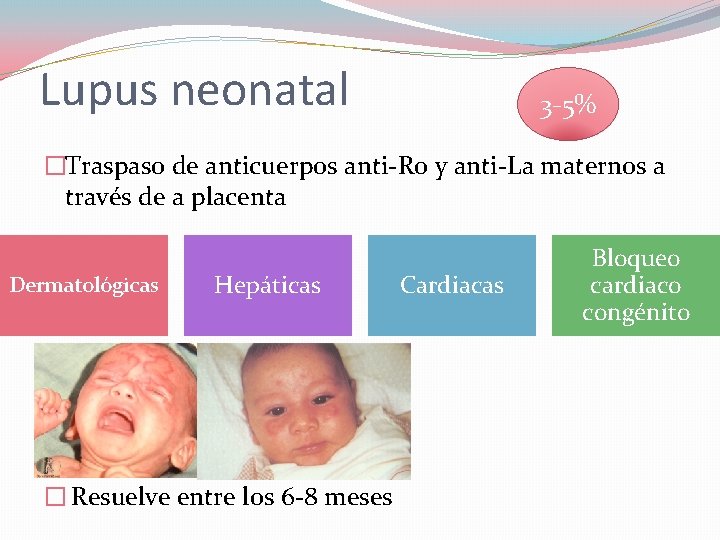 Lupus neonatal 3 -5% �Traspaso de anticuerpos anti-Ro y anti-La maternos a través de