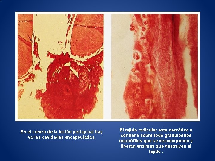 En el centro de la lesión periapical hay varias cavidades encapsuladas. El tejido radicular