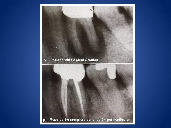 Periodontitis Apical Crónica Resolución completa de la lesión perirradicular 