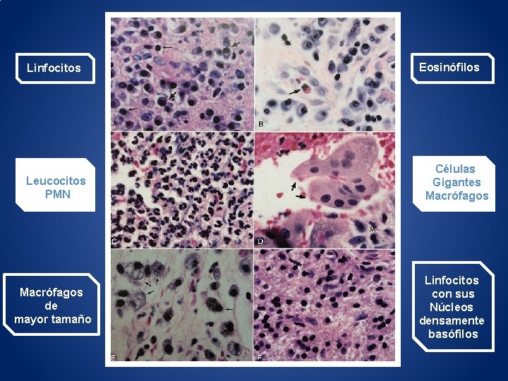Eosinófilos Linfocitos Células Gigantes Macrófagos Leucocitos PMN Linfocitos con sus Núcleos densamente basófilos Macrófagos