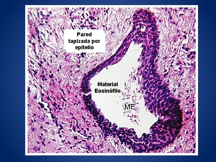 Pared tapizada por epitelio Material Eosinófilo FMC 