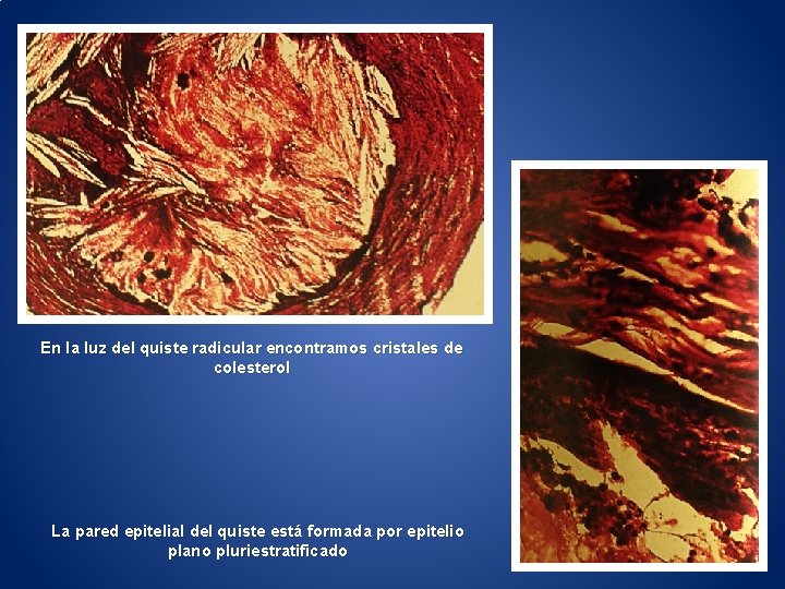 En la luz del quiste radicular encontramos cristales de colesterol La pared epitelial del