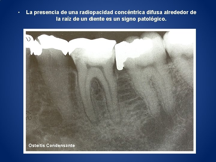  • La presencia de una radiopacidad concéntrica difusa alrededor de la raíz de