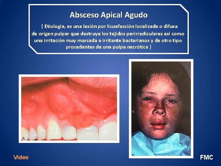 Absceso Apical Agudo ( Etiología, es una lesión por licuefacción localizada o difusa de