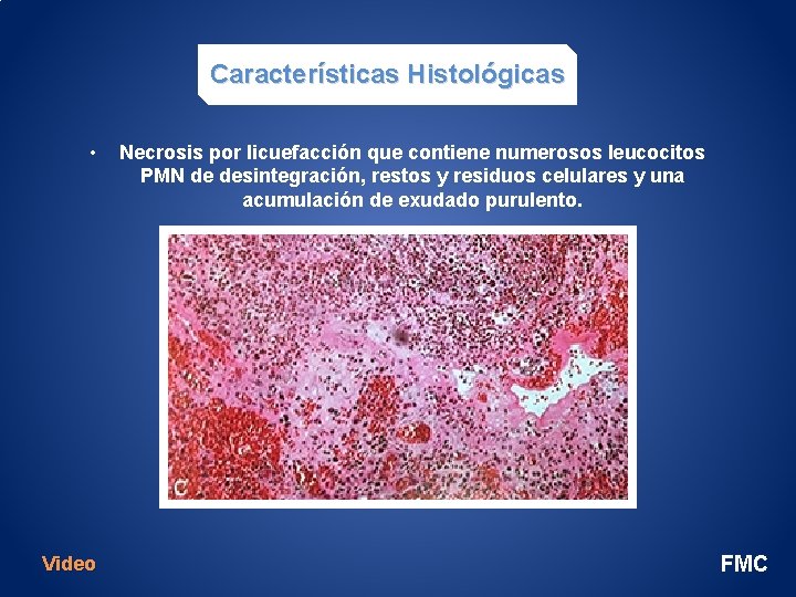 Características Histológicas • Video Necrosis por licuefacción que contiene numerosos leucocitos PMN de desintegración,