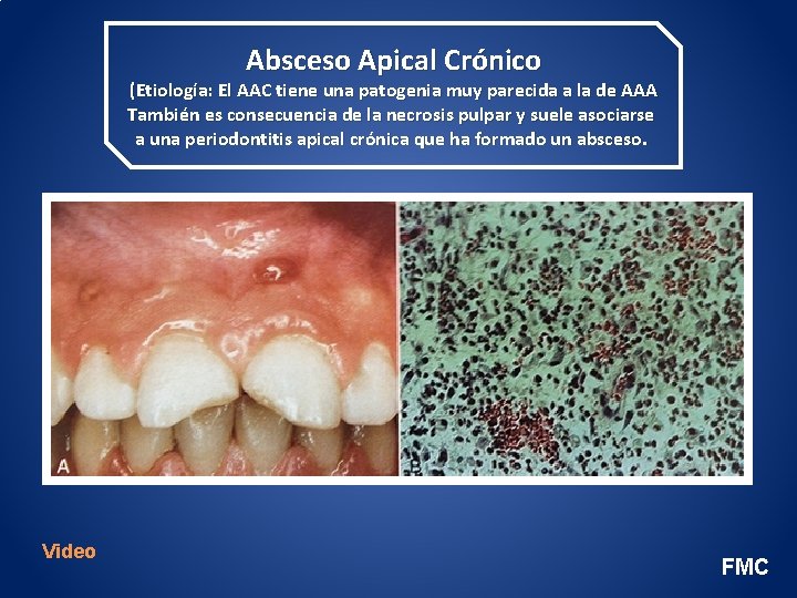 Absceso Apical Crónico (Etiología: El AAC tiene una patogenia muy parecida a la de
