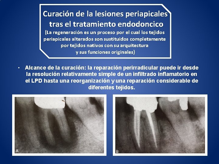 Curación de la lesiones periapicales tras el tratamiento endodoncico (La regeneración es un proceso