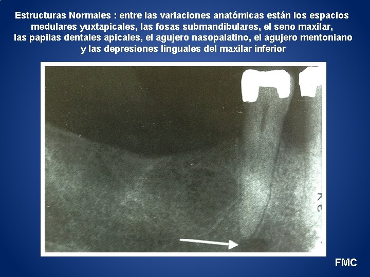 Estructuras Normales : entre las variaciones anatómicas están los espacios medulares yuxtapicales, las fosas