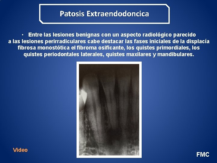 Patosis Extraendodoncica • Entre las lesiones benignas con un aspecto radiológico parecido a las