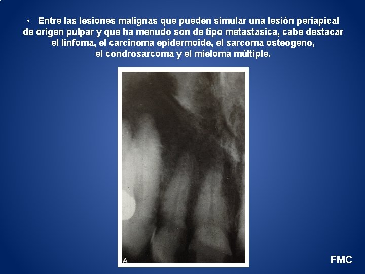  • Entre las lesiones malignas que pueden simular una lesión periapical de origen