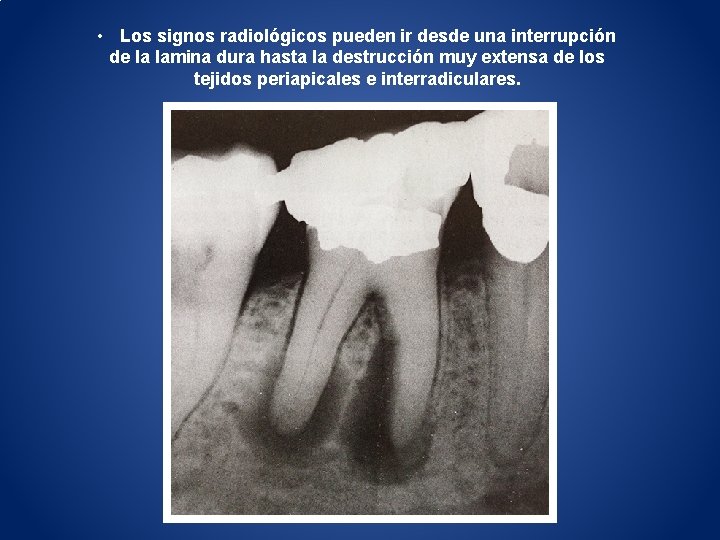  • Los signos radiológicos pueden ir desde una interrupción de la lamina dura