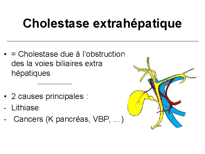 Cholestase extrahépatique • = Cholestase due à l’obstruction des la voies biliaires extra hépatiques