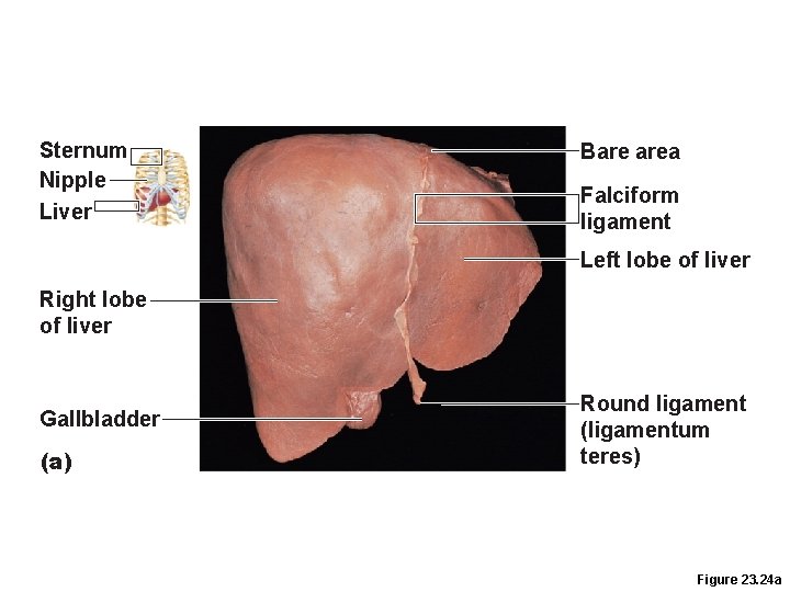 Sternum Nipple Liver Bare area Falciform ligament Left lobe of liver Right lobe of Sternum Nipple Liver Bare area Falciform ligament Left lobe of liver Right lobe of