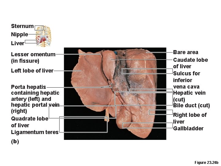 Sternum Nipple Liver Lesser omentum (in fissure) Left lobe of liver Porta hepatis containing Sternum Nipple Liver Lesser omentum (in fissure) Left lobe of liver Porta hepatis containing