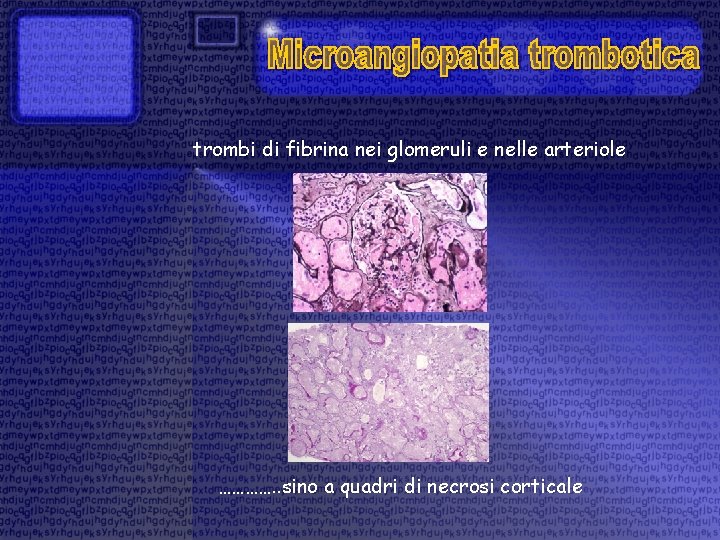 trombi di fibrina nei glomeruli e nelle arteriole …………. . sino a quadri di