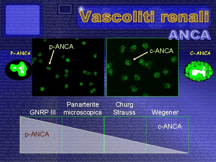 p-ANCA GNRP III Panarterite microscopica c-ANCA Churg Strauss Wegener c-ANCA p-ANCA 