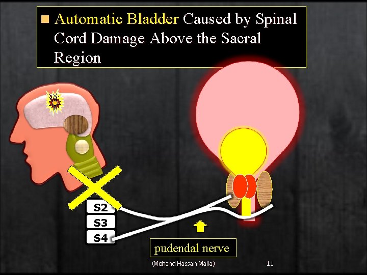 n Automatic Bladder Caused by Spinal Cord Damage Above the Sacral Region S 2