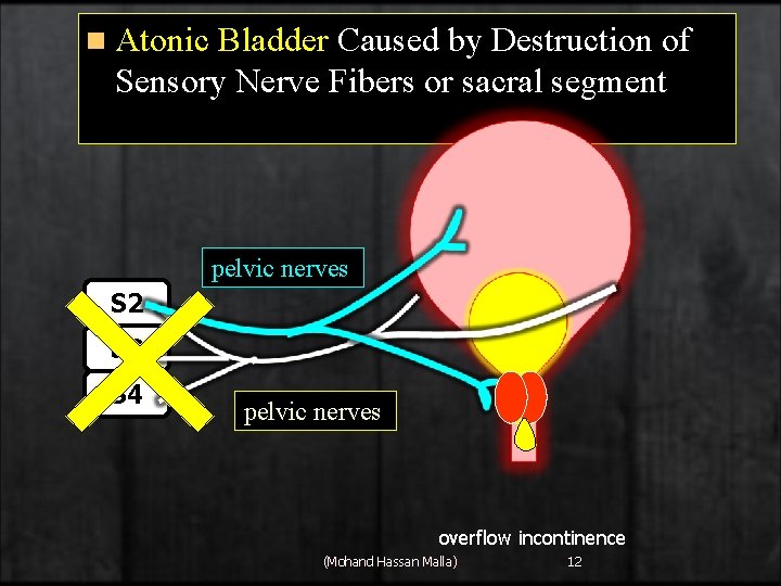 n Atonic Bladder Caused by Destruction of Sensory Nerve Fibers or sacral segment pelvic