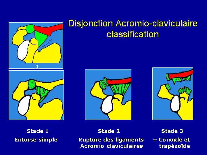 Disjonction Acromio-claviculaire classification Stade 1 Entorse simple Stade 2 Rupture des ligaments Acromio-claviculaires Stade