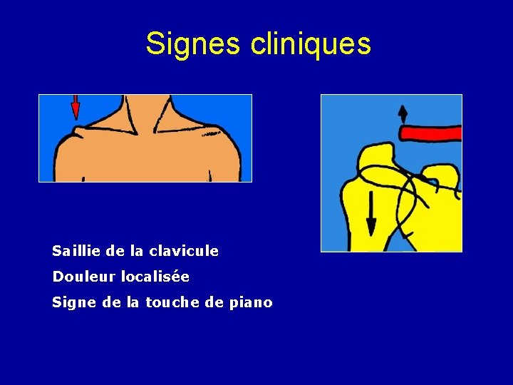 Signes cliniques Saillie de la clavicule Douleur localisée Signe de la touche de piano