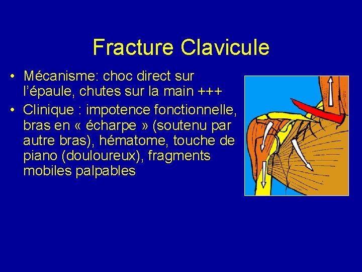 Fracture Clavicule • Mécanisme: choc direct sur l’épaule, chutes sur la main +++ •