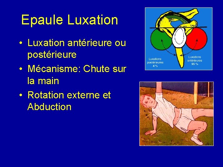 Epaule Luxation • Luxation antérieure ou postérieure • Mécanisme: Chute sur la main •