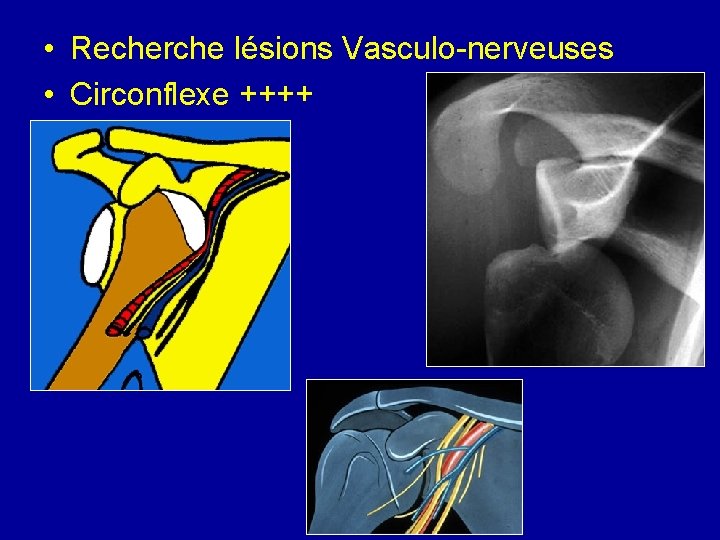  • Recherche lésions Vasculo-nerveuses • Circonflexe ++++ 