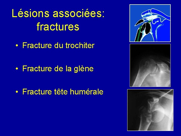 Lésions associées: fractures • Fracture du trochiter • Fracture de la glène • Fracture
