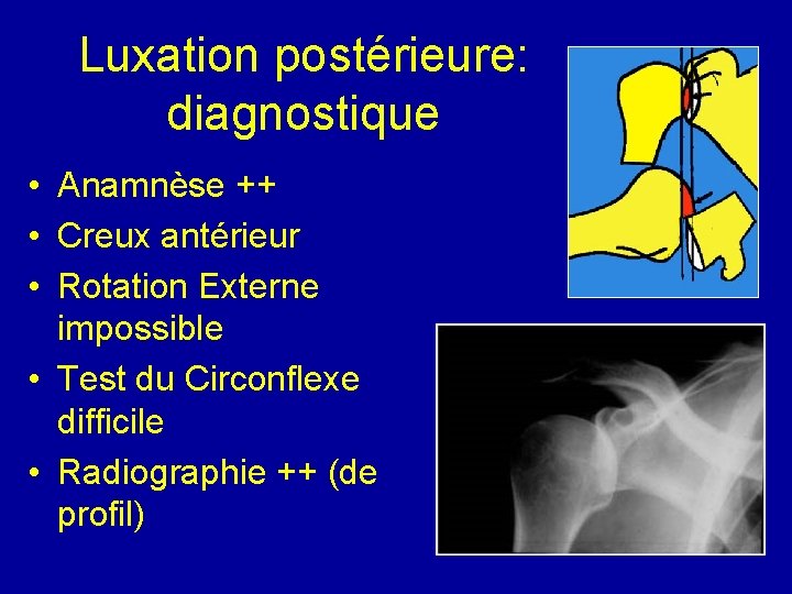 Luxation postérieure: diagnostique • Anamnèse ++ • Creux antérieur • Rotation Externe impossible •