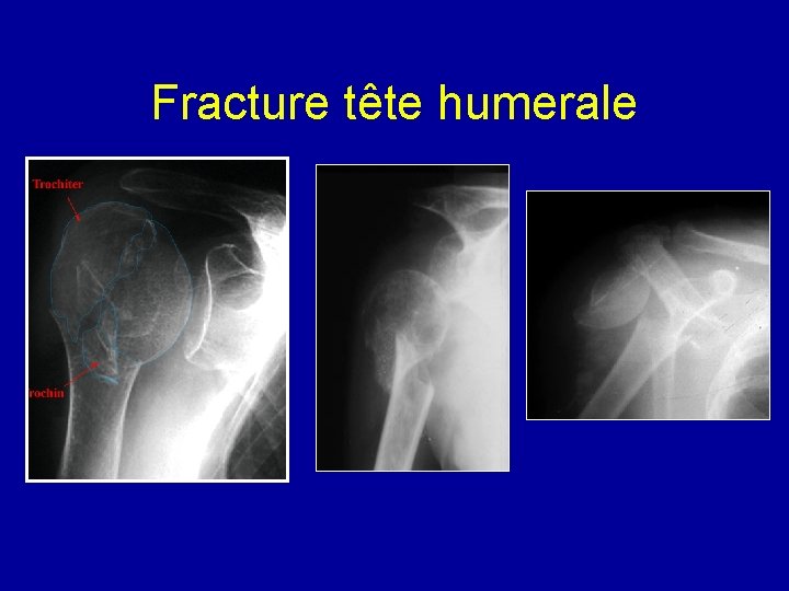 Fracture tête humerale 