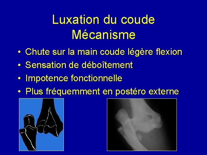 Luxation du coude Mécanisme • • Chute sur la main coude légère flexion Sensation