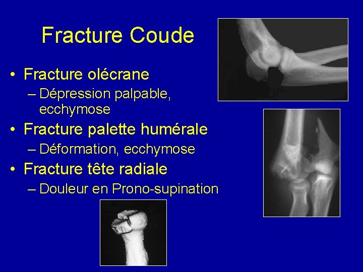 Fracture Coude • Fracture olécrane – Dépression palpable, ecchymose • Fracture palette humérale –