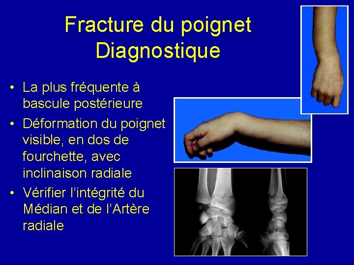 Fracture du poignet Diagnostique • La plus fréquente à bascule postérieure • Déformation du