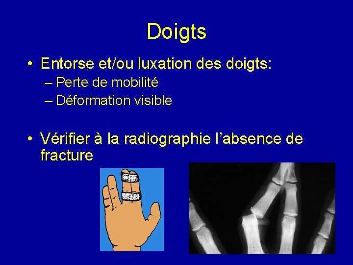 Doigts • Entorse et/ou luxation des doigts: – Perte de mobilité – Déformation visible