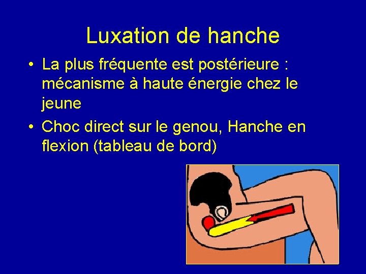 Luxation de hanche • La plus fréquente est postérieure : mécanisme à haute énergie