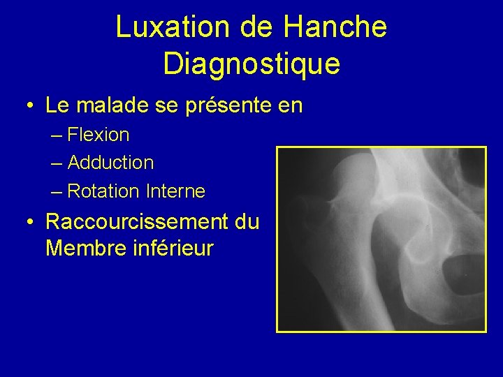 Luxation de Hanche Diagnostique • Le malade se présente en – Flexion – Adduction