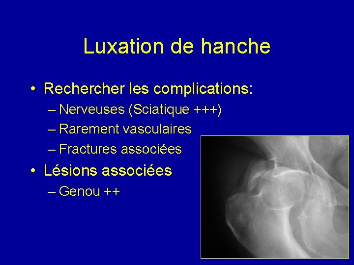 Luxation de hanche • Recher les complications: – Nerveuses (Sciatique +++) – Rarement vasculaires