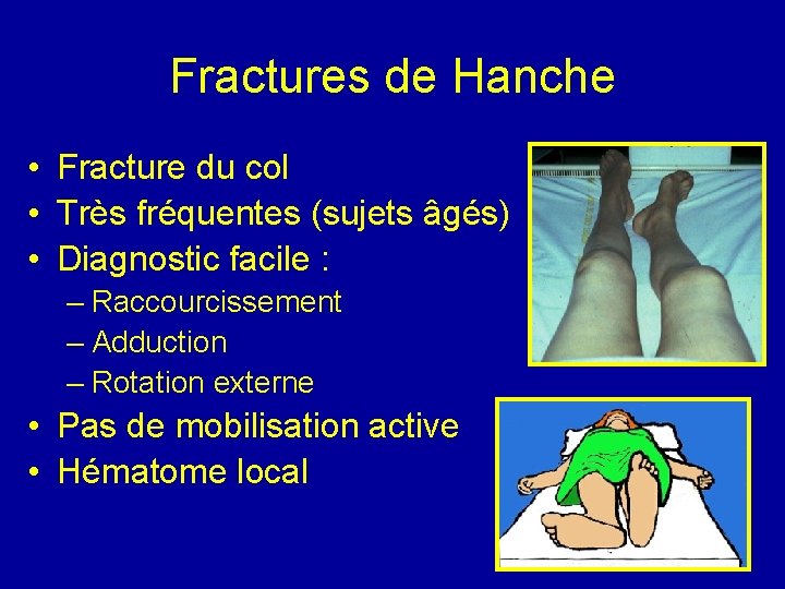 Fractures de Hanche • Fracture du col • Très fréquentes (sujets âgés) • Diagnostic