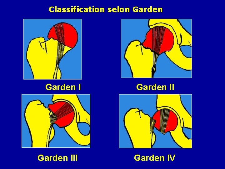Classification selon Garden II Garden IV 