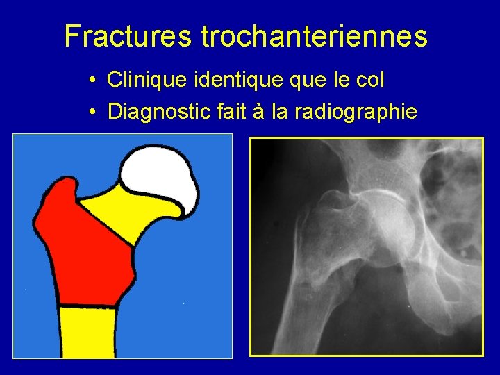 Fractures trochanteriennes • Clinique identique le col • Diagnostic fait à la radiographie 