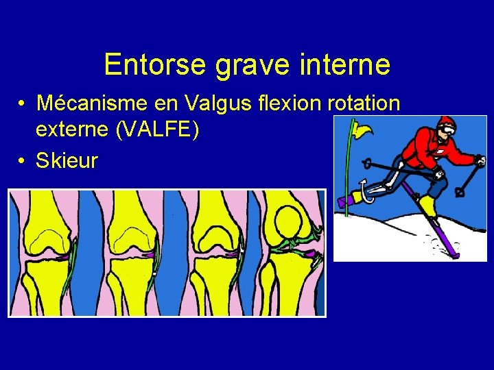 Entorse grave interne • Mécanisme en Valgus flexion rotation externe (VALFE) • Skieur 